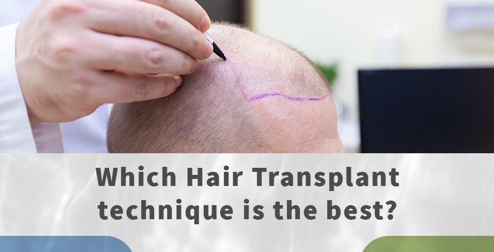 WHICH HAIR TRANSPLANT TECHNIQUE IS THE BESTwhı