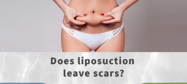 does liposuction leave scars