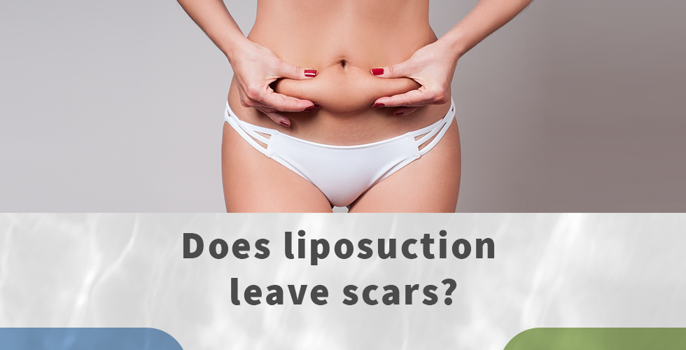 does liposuction leave scars