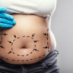 5 etapas del proceso de recuperación de la abdominoplastia